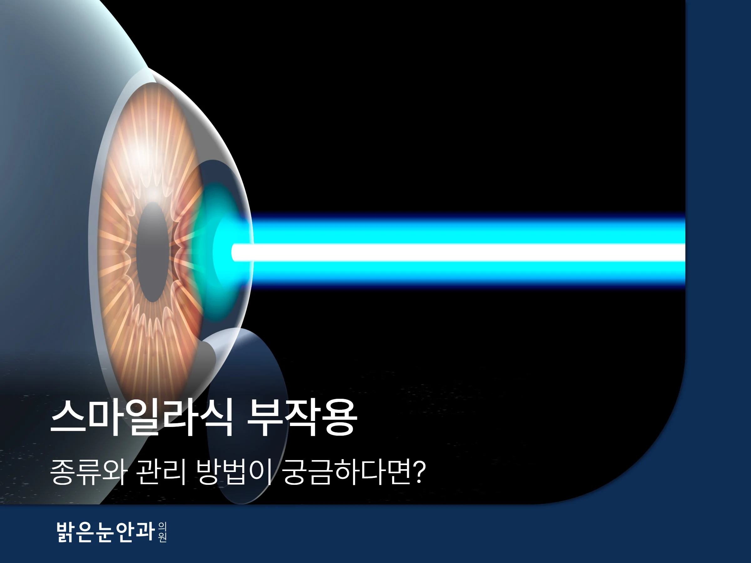 스마일라식 부작용 썸네일