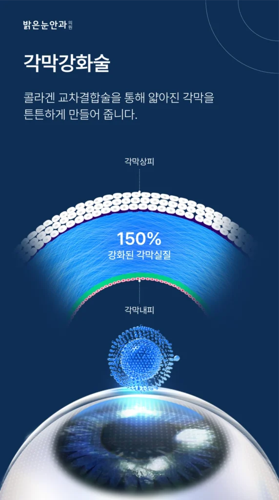 스마일라식 부작용