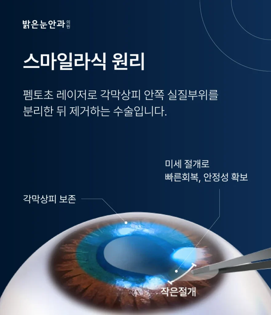 스마일라식 부작용