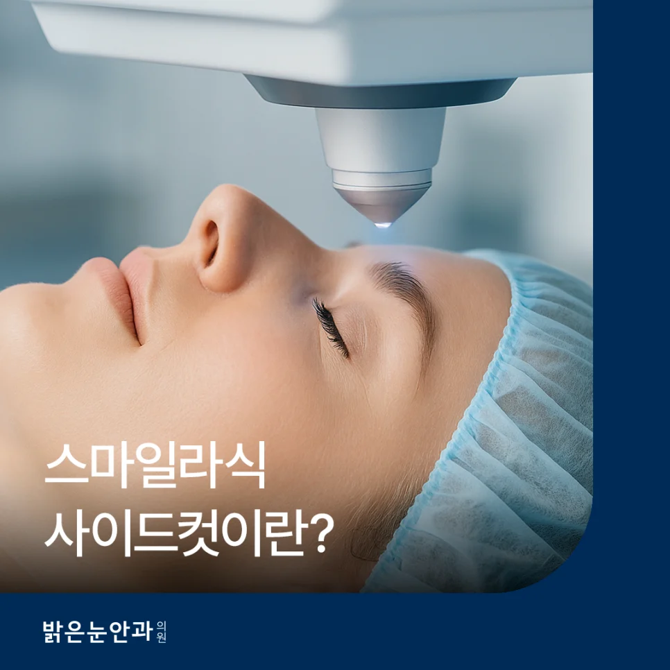 스마일라식 사이드컷