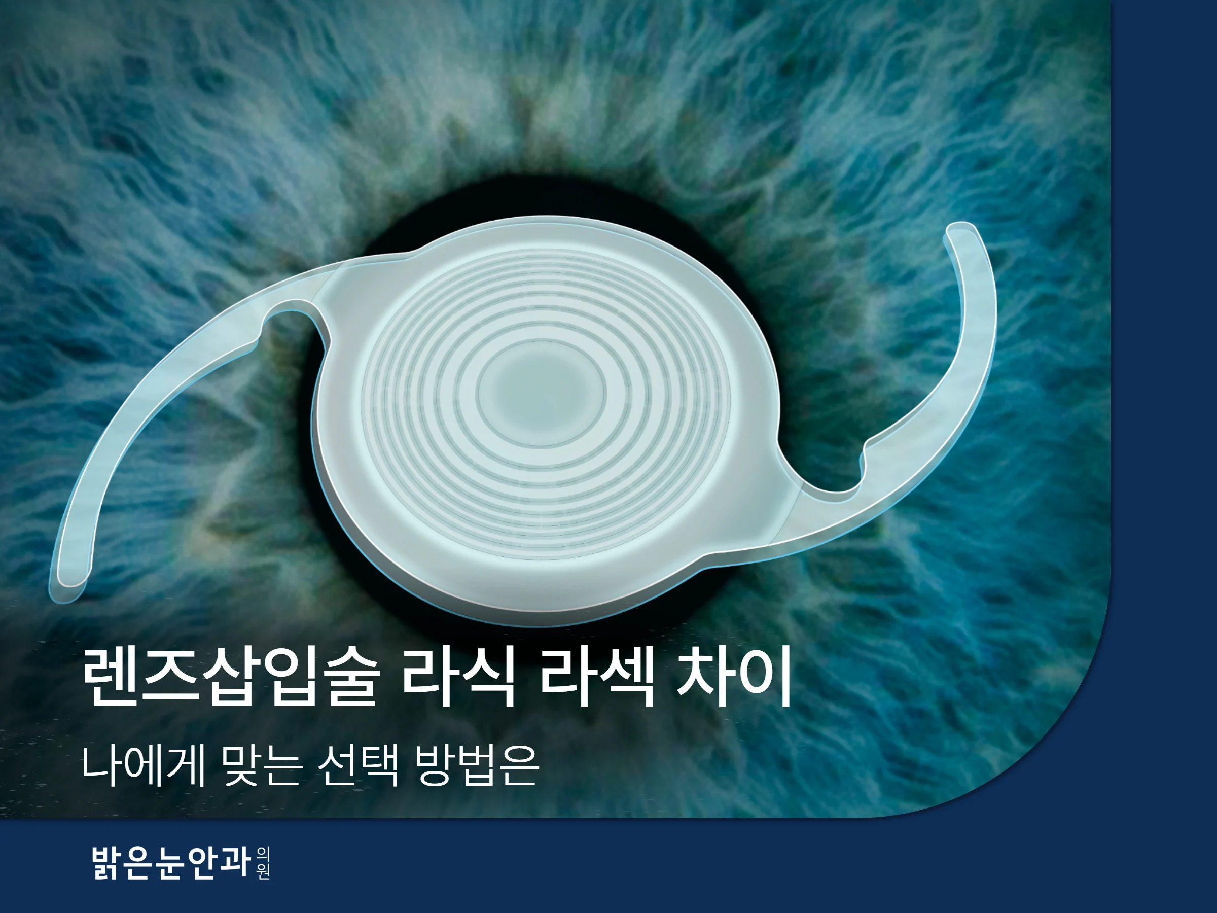 렌즈삽입술 라식 라섹 차이 썸네일