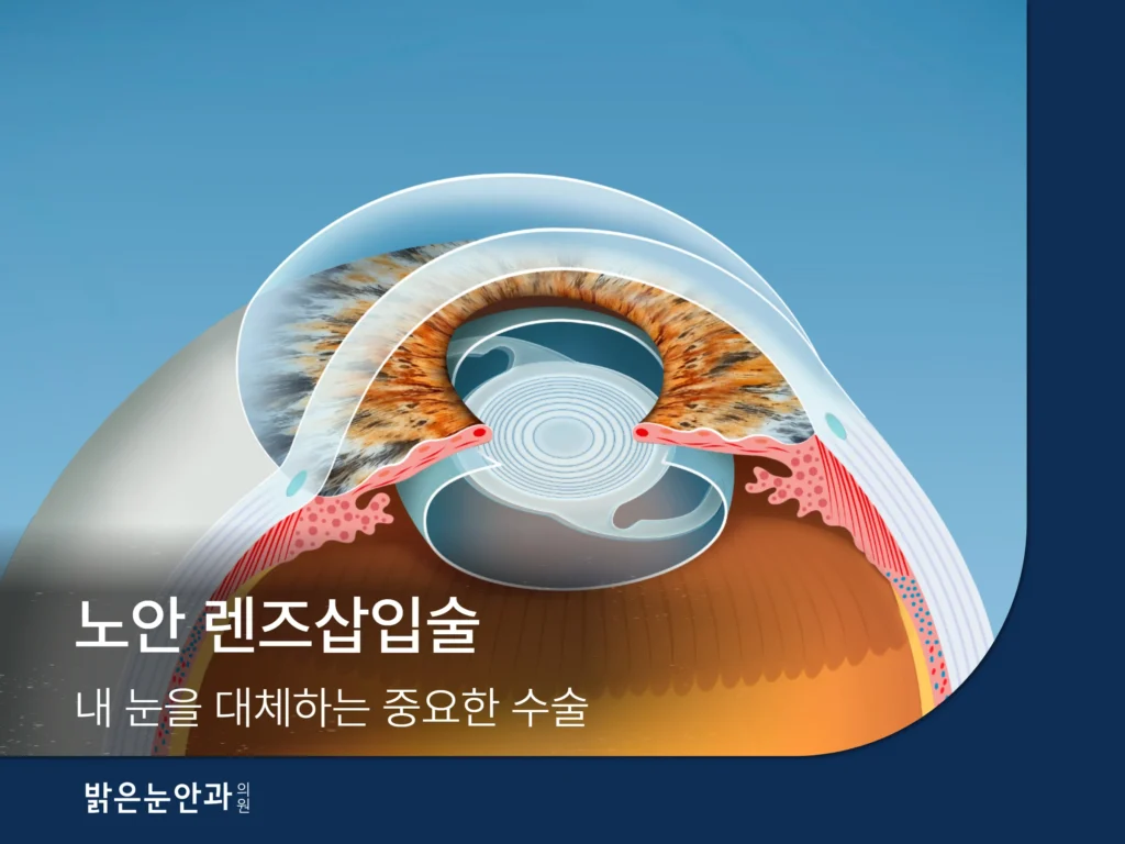 노안-렌즈삽입술- 썸네일