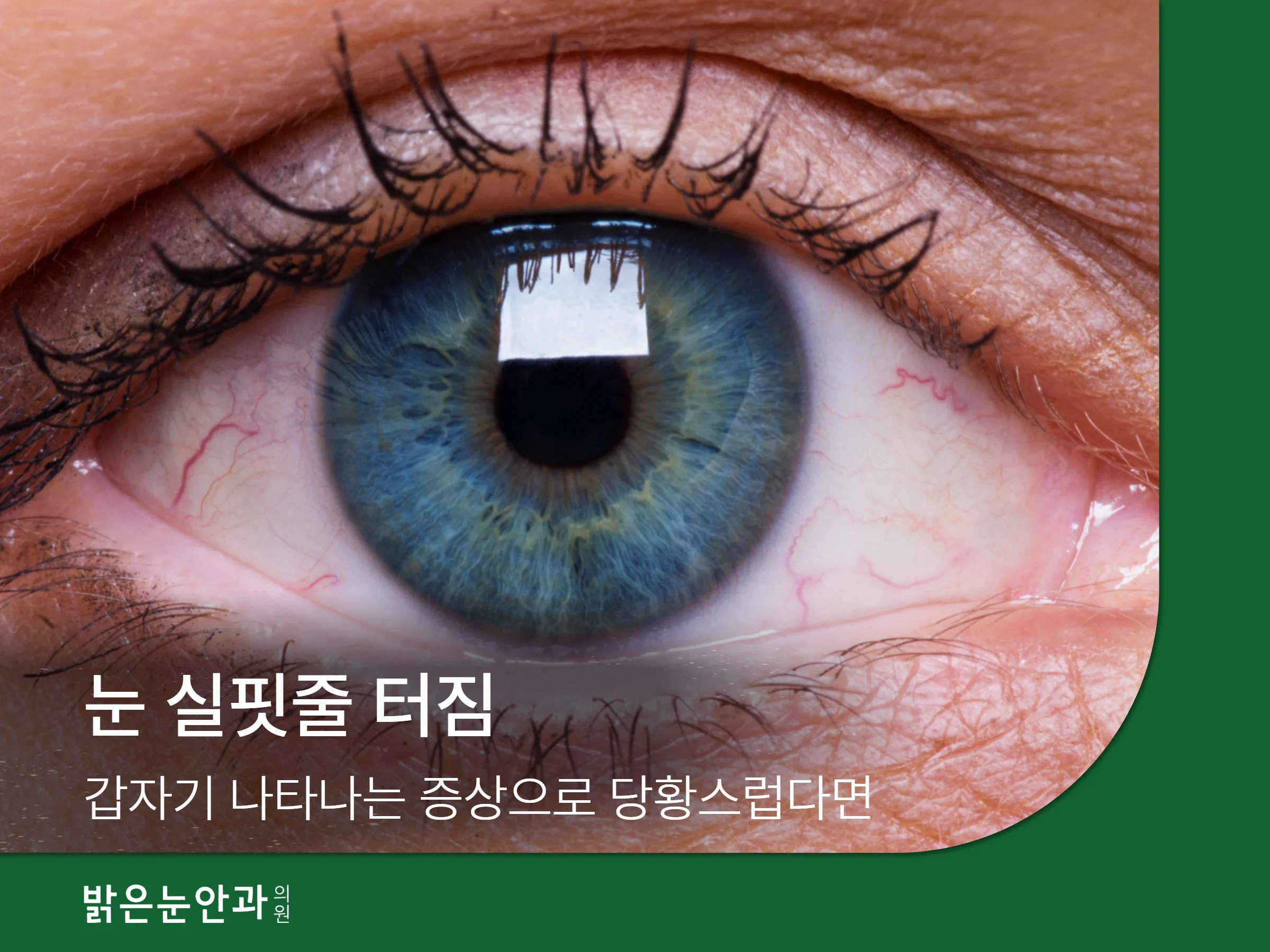 눈 실핏줄 터짐 갑자기 나타나는 증상으로 당황스럽다면 - 밝은눈안과 강남 공식 블로그