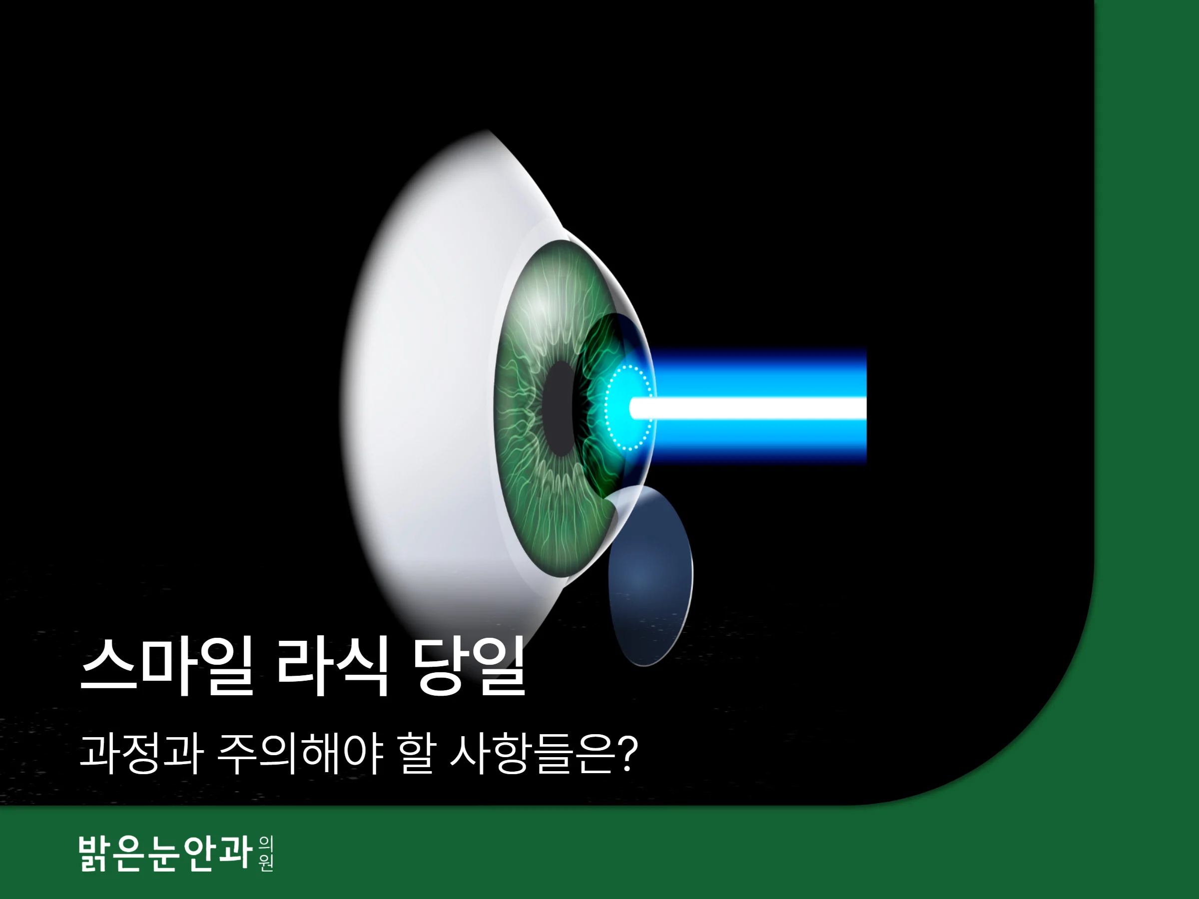 스마일 라식 당일