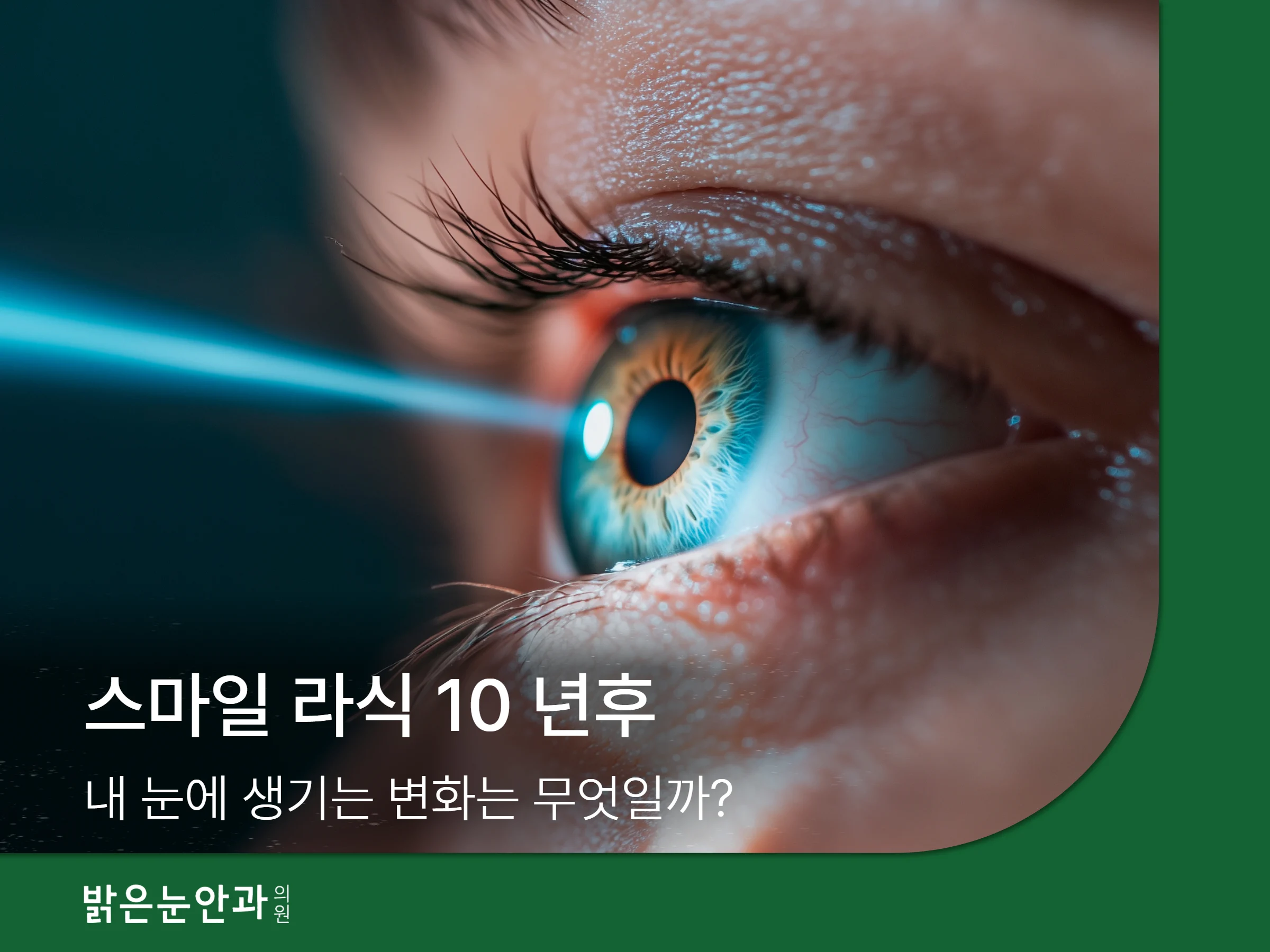 스마일 라식 10 년후
