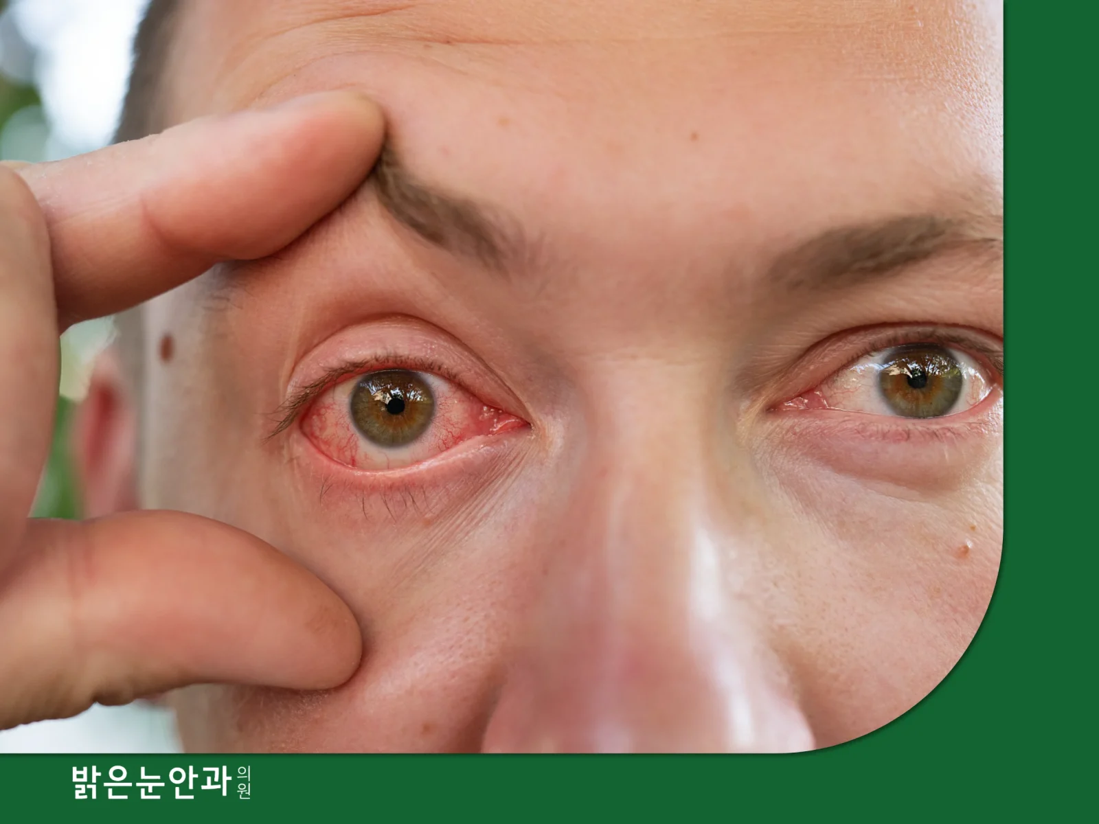 결막염 증상
