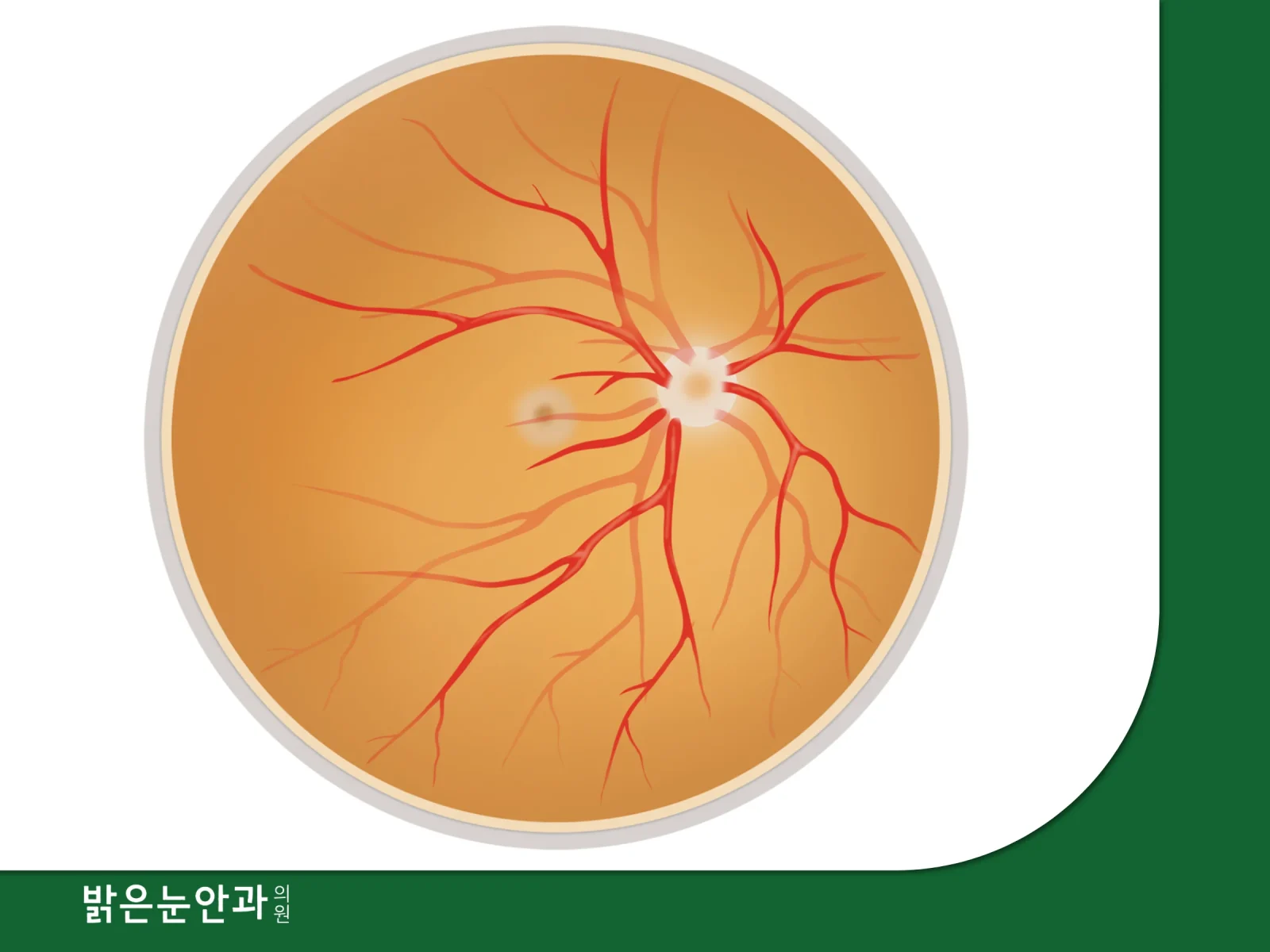 노년성 황반변성