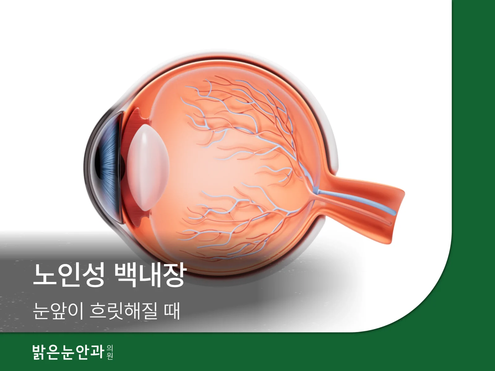 노인성 백내장