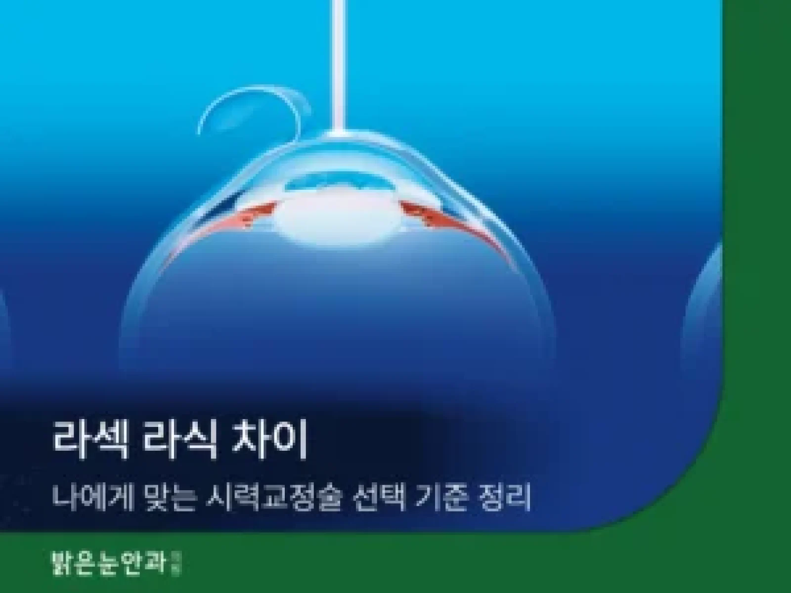 라섹-라식-차이-300x225