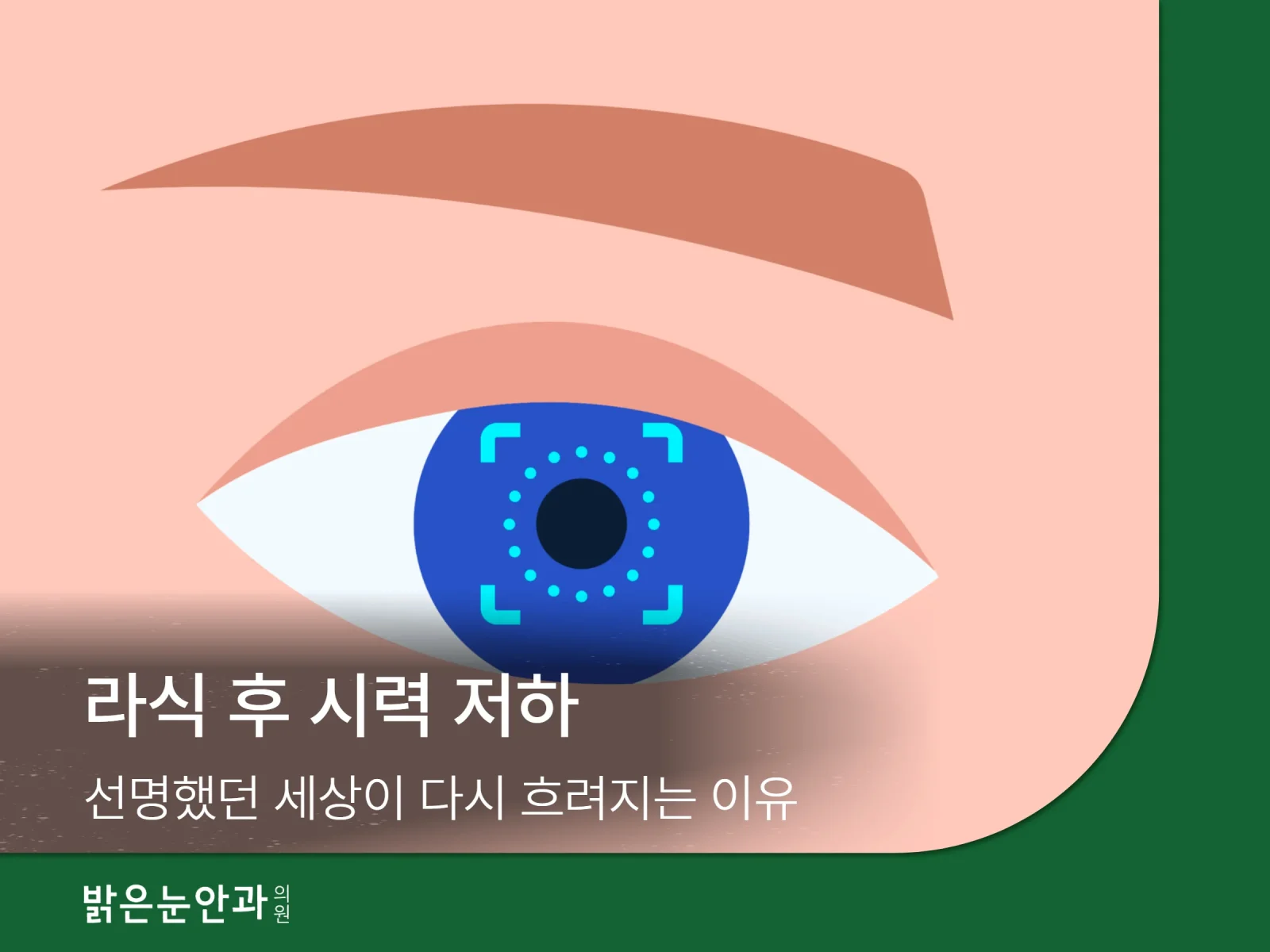 라식 후 시력