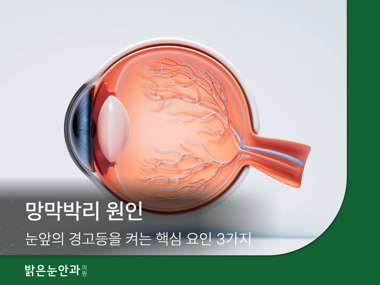 망박비리 원인