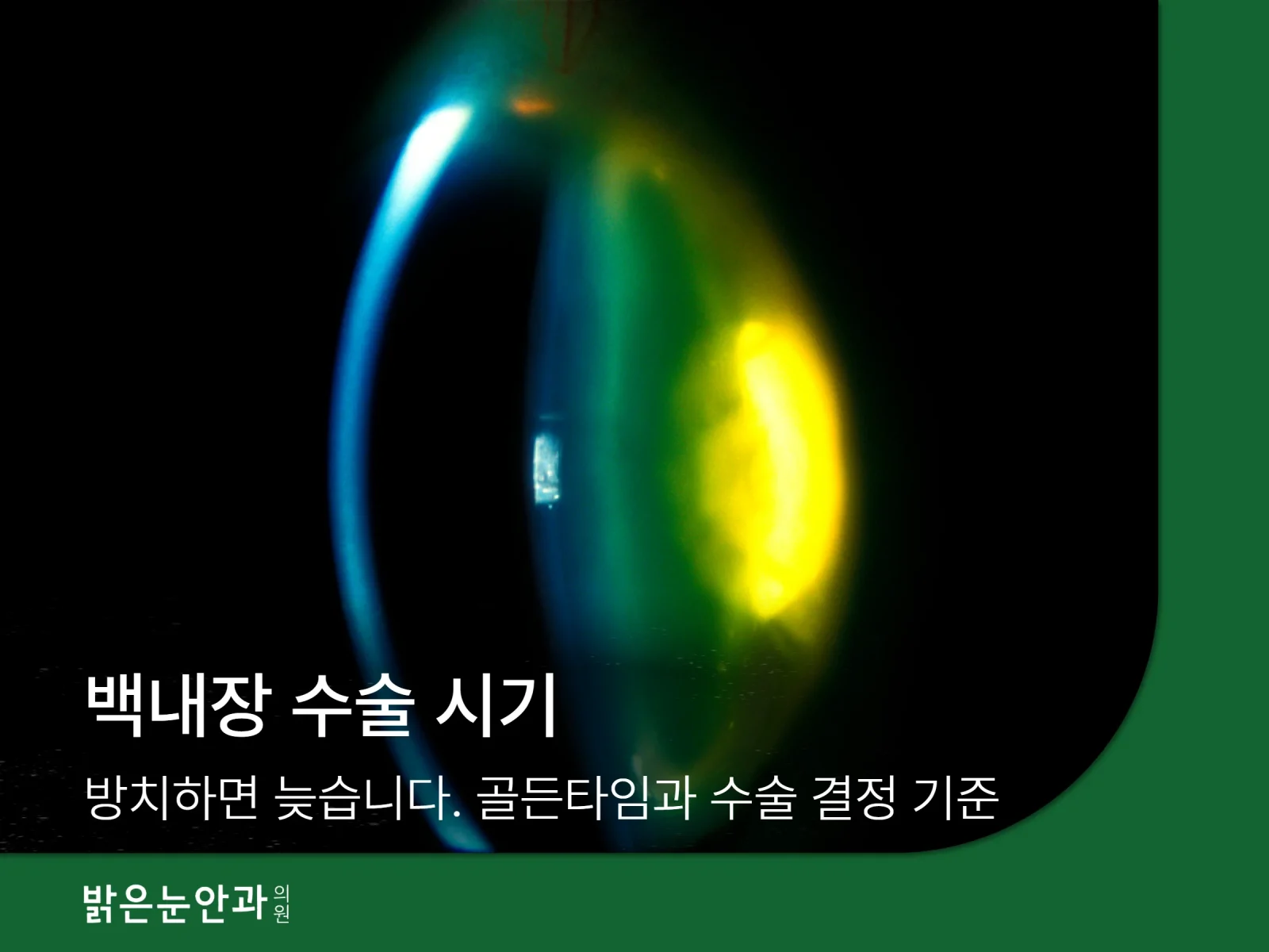 백내장 수술 시기