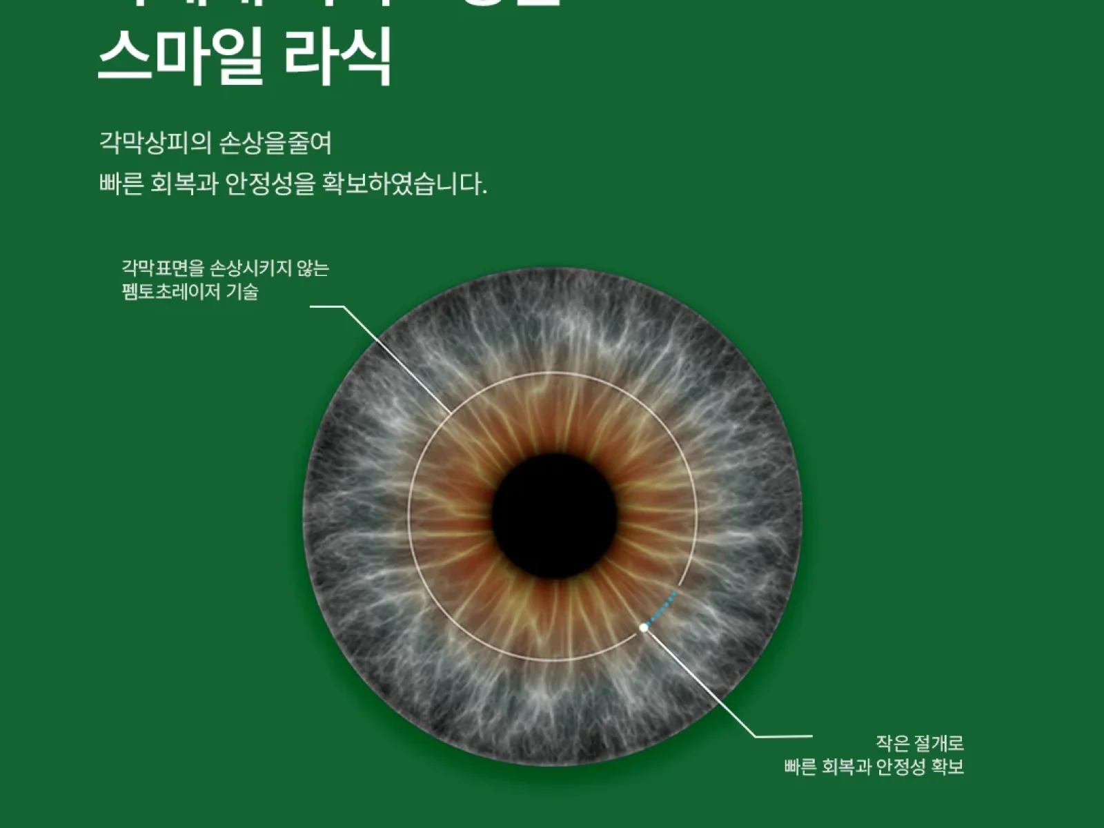 스마일 라식 vs 라섹