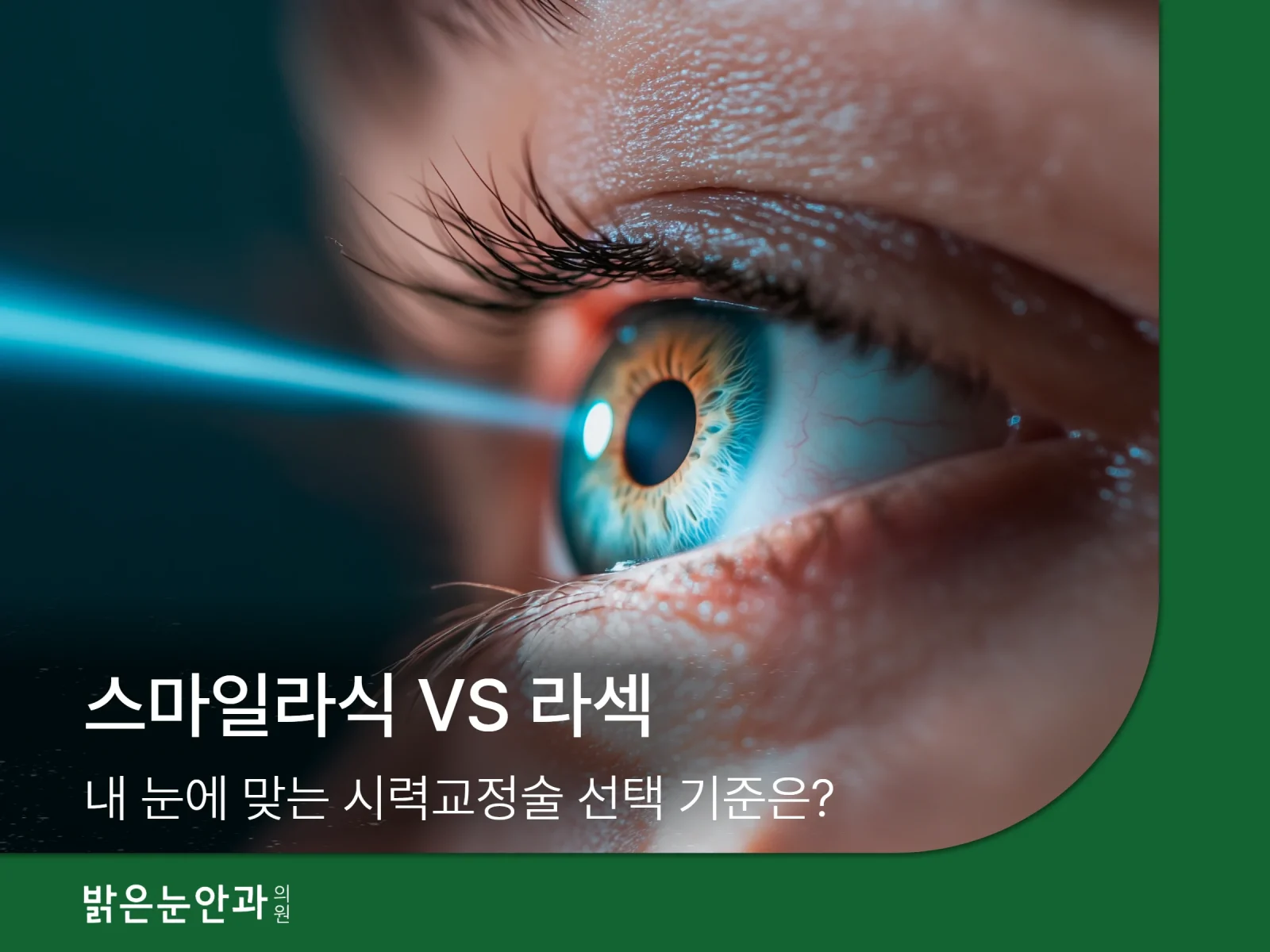 스마일라식 VS 라섹