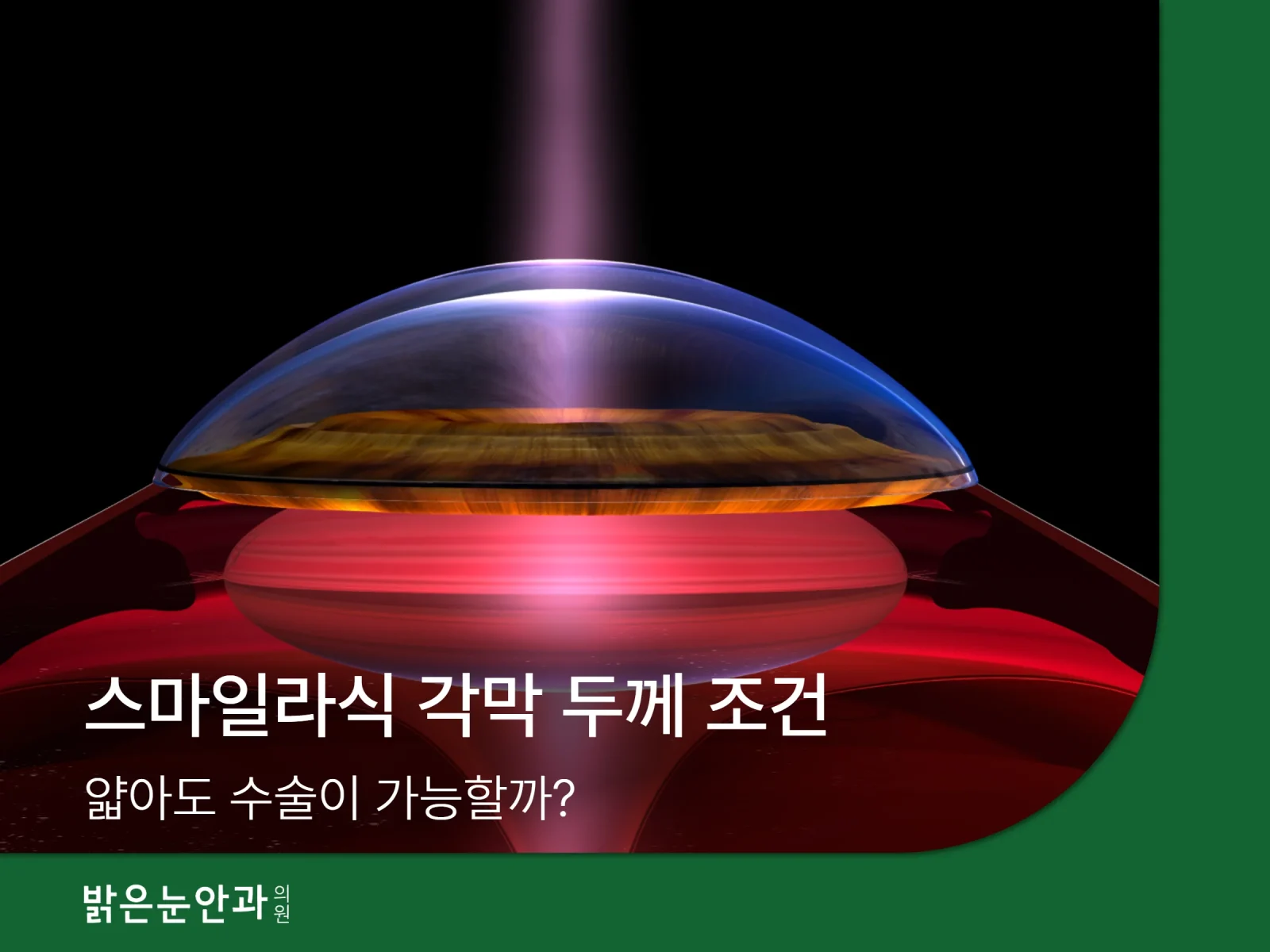 스마일라식 각막두께
