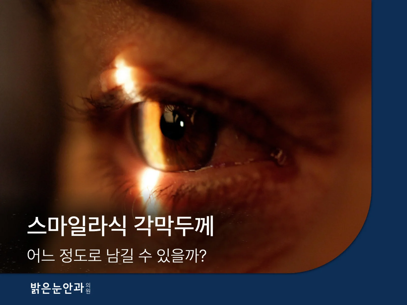 스마일라식 각막두께 어느 정도로 남길 수 있을까