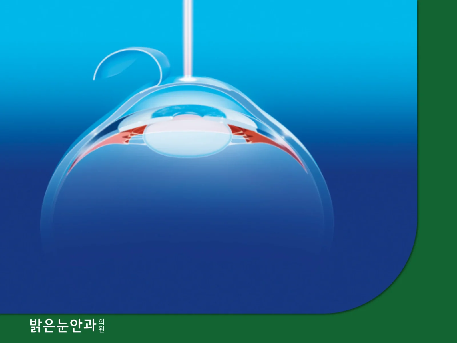 스마일라식 다음날 시력