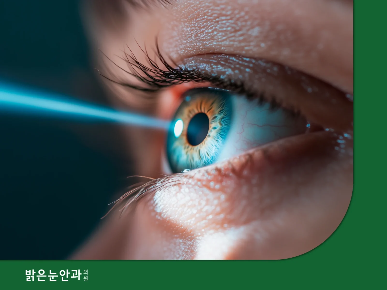 스마일라식 라섹 차이
