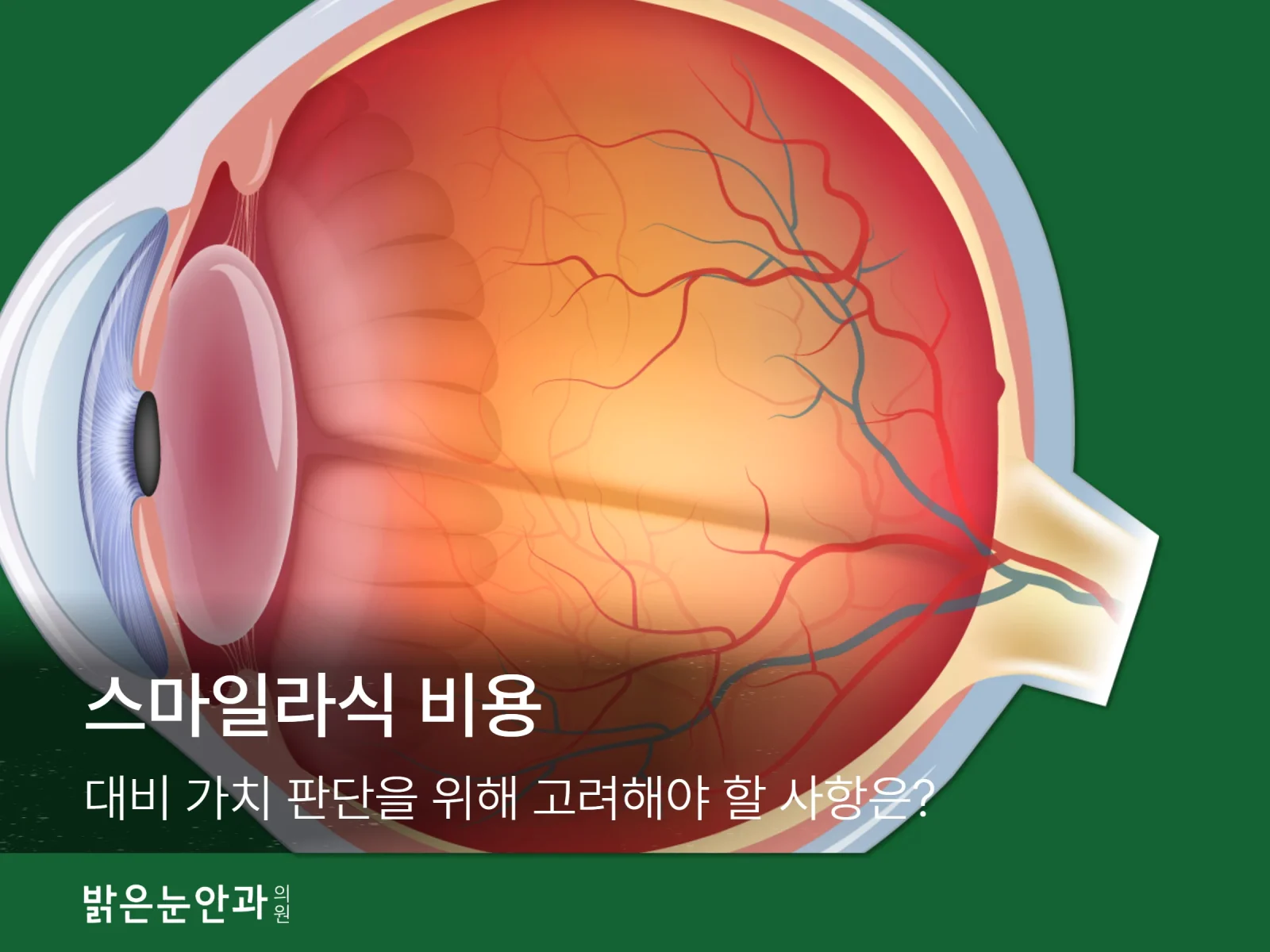 스마일라식 비용