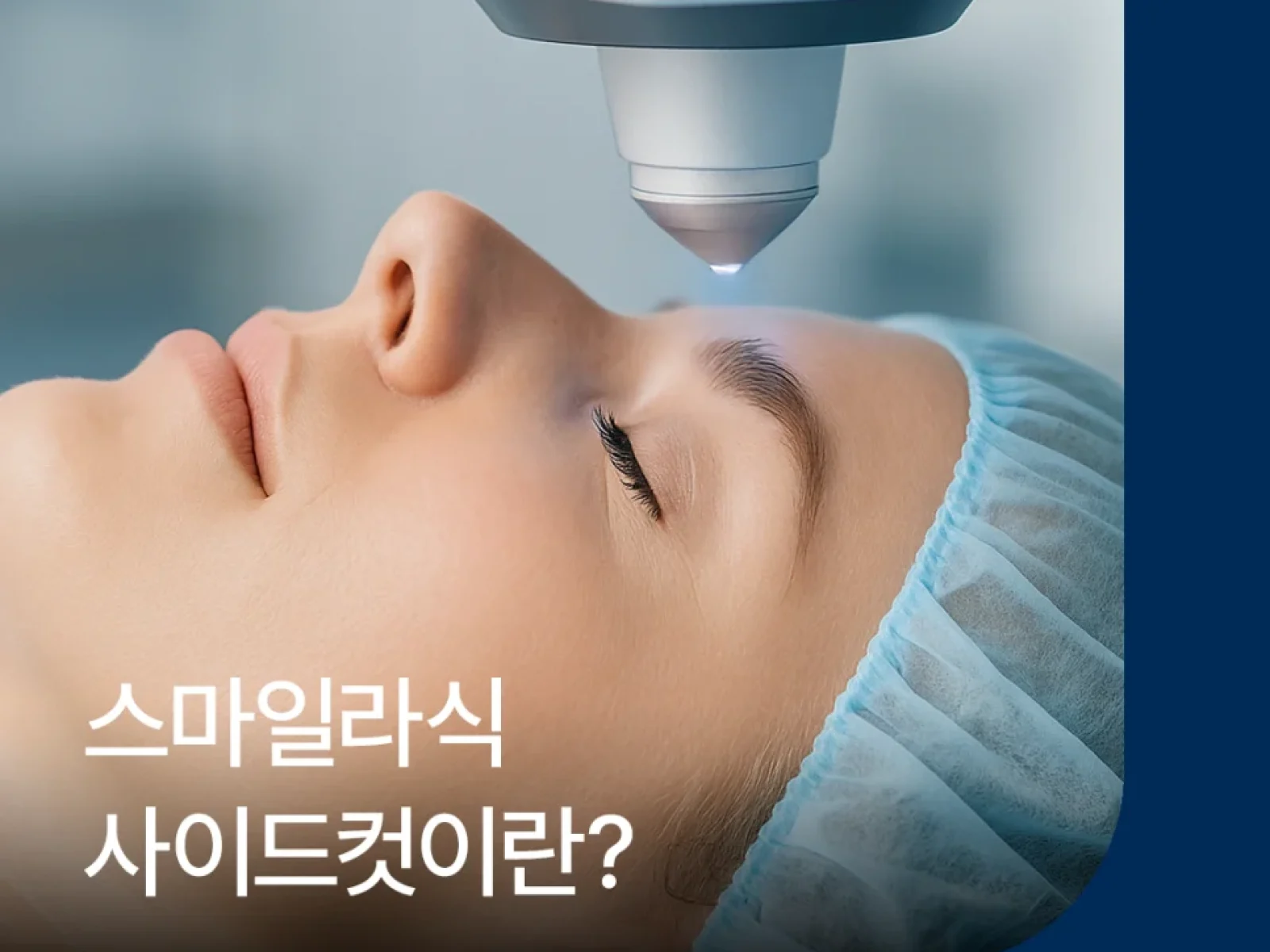 스마일라식 사이드컷