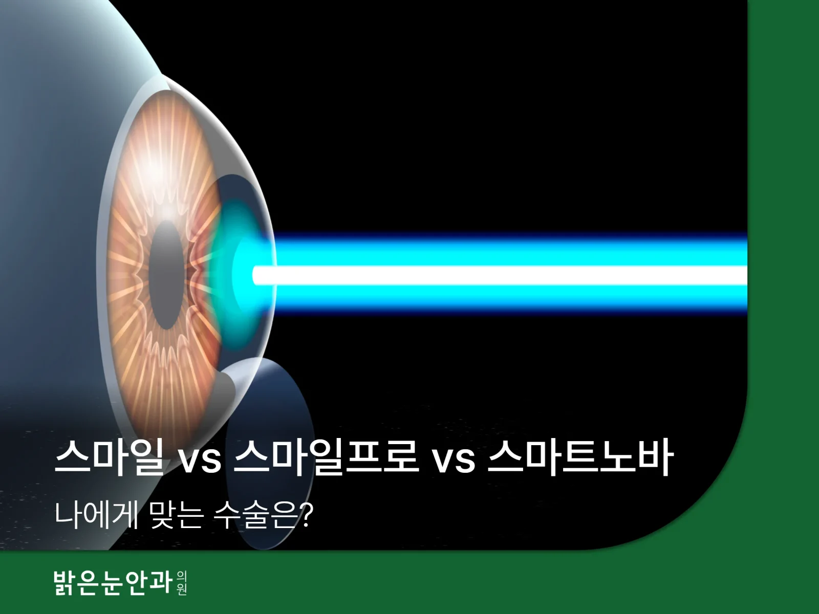 시력교정술 비교