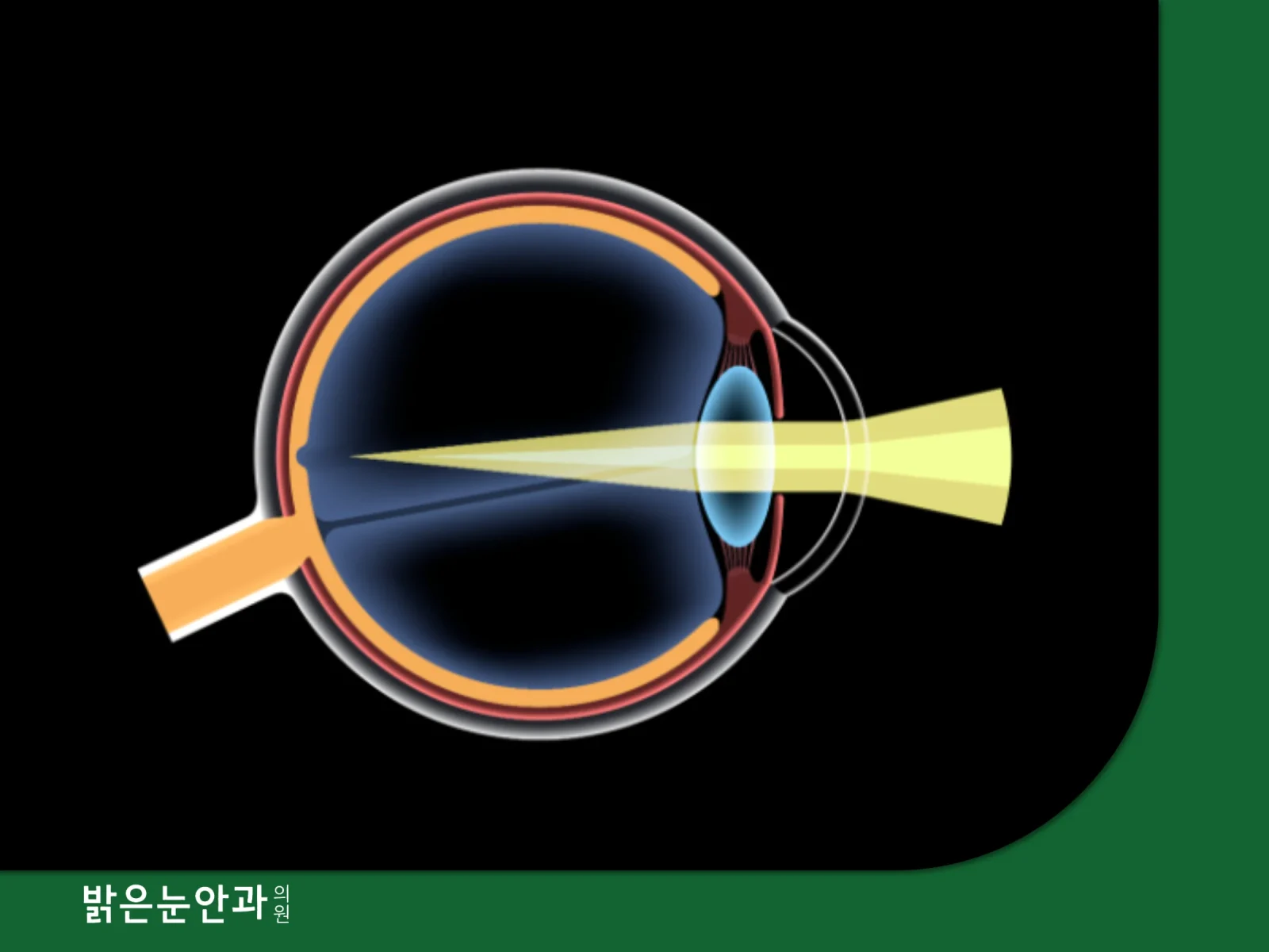 초고도근시 라섹