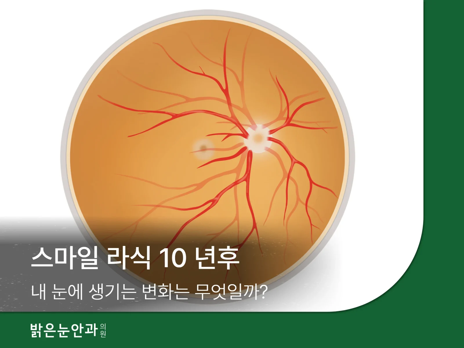황반변성 원인